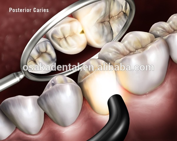 علاج الأسنان أدى ضوء علاج الأسنان أدى ضوء العلاج اللاسلكي