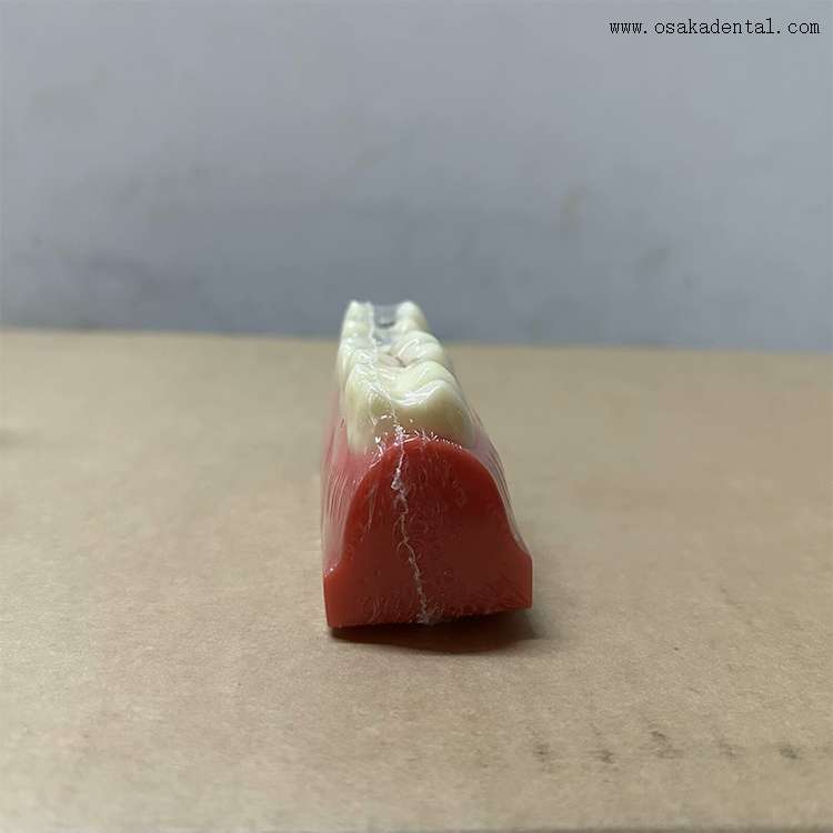 نموذج توضيحي لحفرة الأسنان والشقوق المانعة للتسرب 