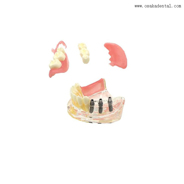 نموذج مقارنة ترميم زراعة الأسنان لتدريس طبيب الأسنان