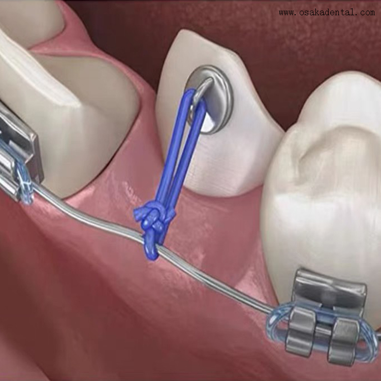 ملحقات تقويم الأسنان، خيط طاقة لتقويم الأسنان بطول 25 قدم 
