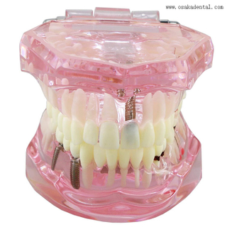 نموذج زراعة الأسنان لتدريس طبيب الأسنان