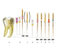 Niti Proter Golden Heat Activation ملف الأسنان